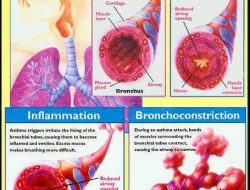 Tips Menjaga Asma Tetap Optimal: Panduan Lengkap untuk Kualitas Hidup Lebih Baik